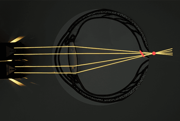 Дефекты зрения